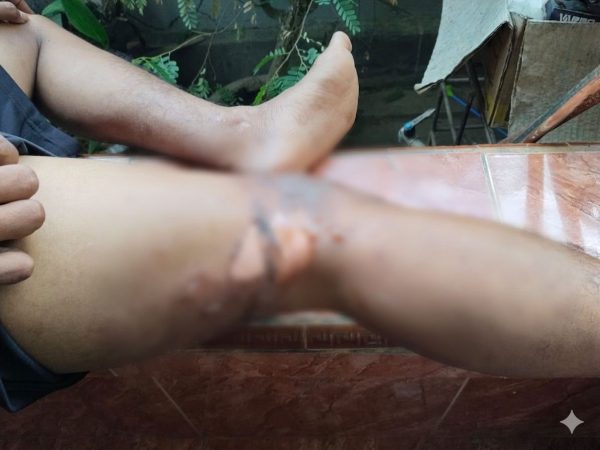 Disiram Air Panas Saat Tagih Utang, Wanita di Kendari Laporkan Istri Polisi ke Polresta
