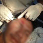 Tragis! Dibacok Beramai-ramai hingga Buta, Pemuda di Bau-Bau Malah Jadi Tersangka